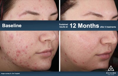 Accure Acne Announces New FDA Clearance for the Lo
