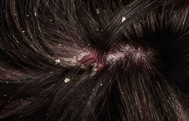 How to get rid of dandruff?