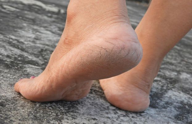 How to get rid of dry skin on your feet?