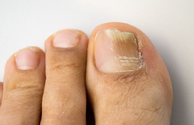 How to treat cracked nails?