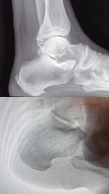 Newport News Foot & Ankle Surgeon Performs First M