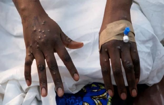 WHO approves Bavarian Nordic’s mpox vaccine for adolescents