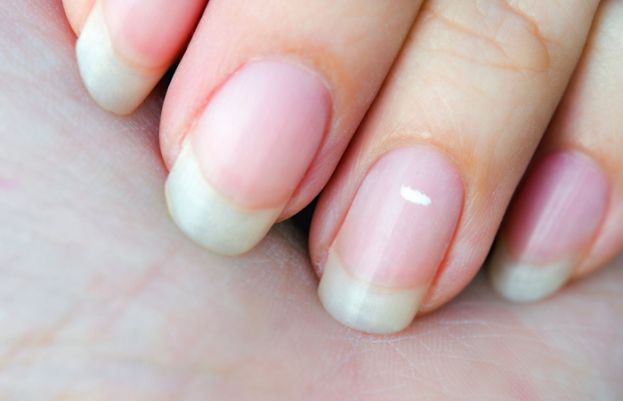 What are the white dots on my nails?